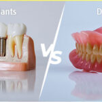 Dental Implants vs. Dentures: Which Is Right for You?
