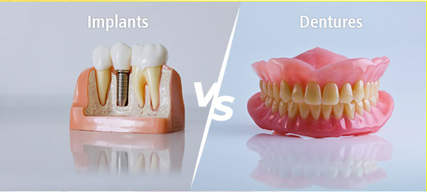 Dental Implants vs. Dentures: Which Is Right for You?