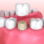 How Dental Crowns Support Teeth After Root Canal Treatments