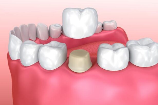 How Dental Crowns Support Teeth After Root Canal Treatments
