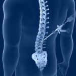 Different Types of Spine Surgery Procedures