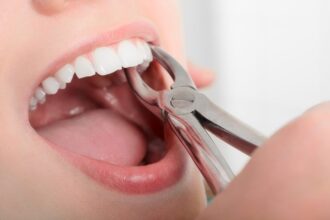 How To Choose Between Simple and Surgical Tooth Extractions