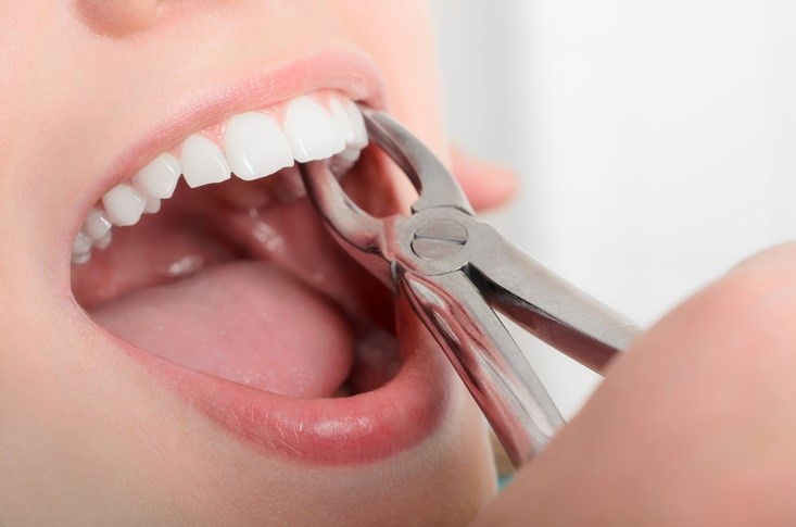 How To Choose Between Simple and Surgical Tooth Extractions