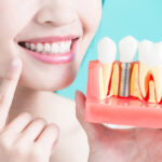 Post-Procedure Care: How to Maintain Your Dental Implants