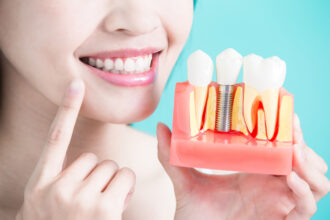 Post-Procedure Care: How to Maintain Your Dental Implants