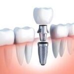 The Cost of Dental Implants and How to Make Them Affordable