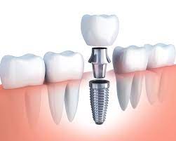 The Cost of Dental Implants and How to Make Them Affordable