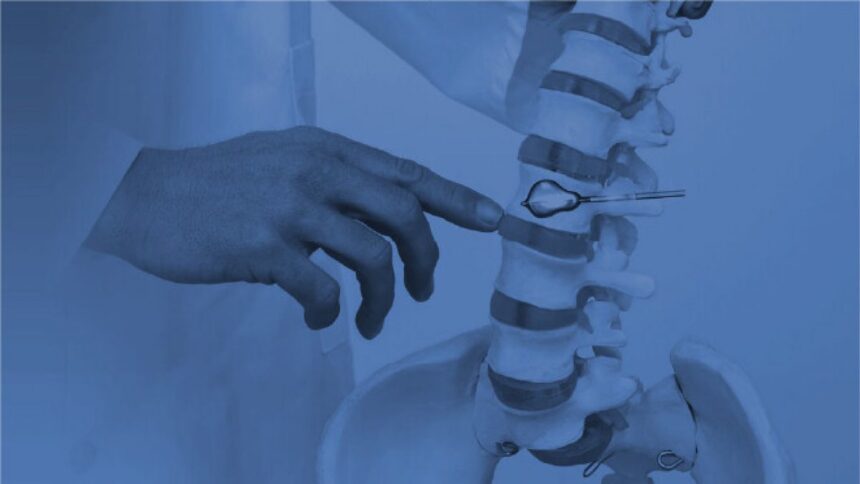 Understanding the Kyphoplasty Procedure for Spine Restoration