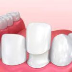 Veneers for Gaps, Cracks, and Imperfections