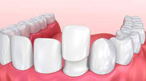 Veneers for Gaps, Cracks, and Imperfections