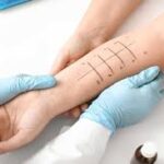 What To Expect From an Allergy Testing Procedure