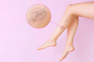 What You Need To Know About Varithena for Treating Varicose Veins