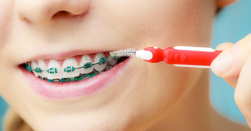 Care for Your Braces