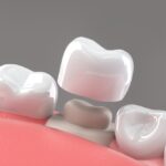 Dental Crowns