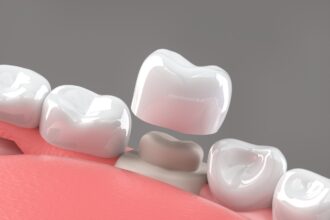 Dental Crowns