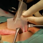 Hernia Surgery Techniques