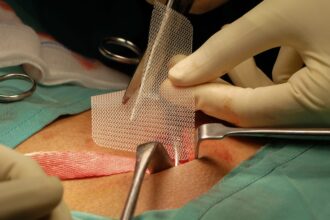 Hernia Surgery Techniques