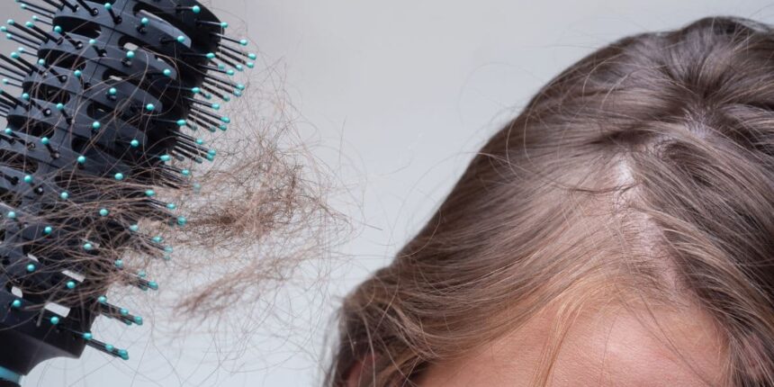 Hormonal Hair Loss
