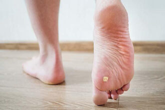 Identify and Treat Warts on Your Feet