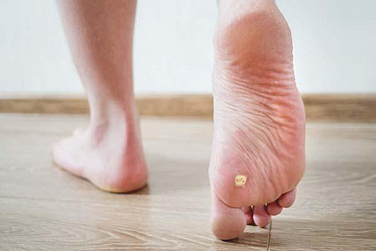 Identify and Treat Warts on Your Feet
