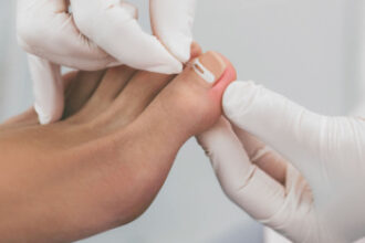 Ingrown Toenail Pain