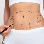 Liposuction Recovery