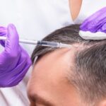 PRP for Hair Loss Prevention and Growth