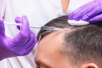 PRP for Hair Loss Prevention and Growth