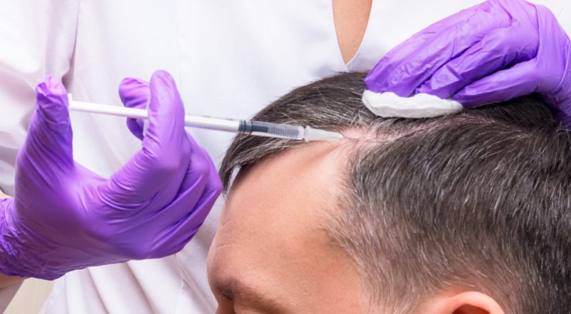 PRP for Hair Loss Prevention and Growth