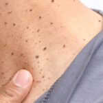 Seborrheic Keratosis