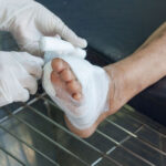 Amputation in Diabetic Patients