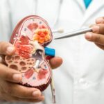 Benefits of Cryoablation for Tumor Treatment