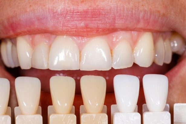 Dental Veneers