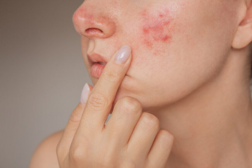 Different Types of Acne