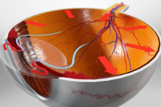 Different Types of Glaucoma