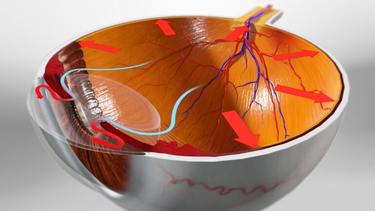 Different Types of Glaucoma