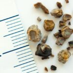 Different Types of Kidney Stones