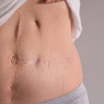 Gallbladder Removal Surgery