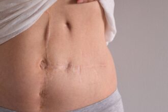 Gallbladder Removal Surgery