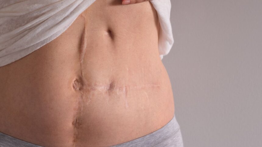 Gallbladder Removal Surgery