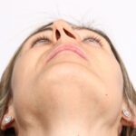 Impact of a Deviated Septum