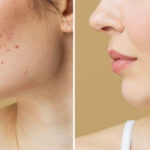 Reduce Visible Scars