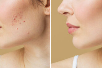 Reduce Visible Scars