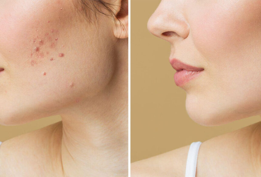 Reduce Visible Scars