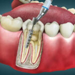 Root Canal Procedure
