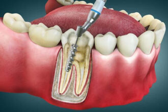 Root Canal Procedure