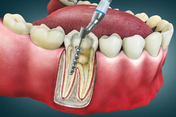 Root Canal Procedure