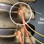 Spinal Stenosis