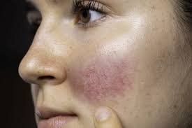 Treating Rosacea Warts