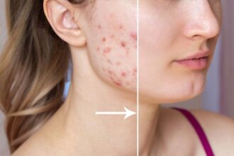Treatments for Acne and Scarring